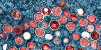 Gesundheitsamt warnt: Mpox-Infektionen jetzt auch in Berlin In Berlin zirkulieren Mpox-Viren, so dass Infektionen auch hier möglich sind. (Archivfoto)