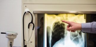 Tuberkulose-Fall in Kita – 130 Menschen müssen zum Bluttest Eine Lungentuberkulose (Tbc) – hier ein Röntgenbild – ist eine ansteckende Infektionskrankheit, die durch Bakterien verursacht wird. (Symbolbild)