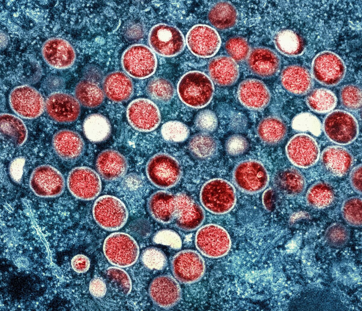 Mpox weitet sich in Berlin auf neue Personengruppen aus Die eitrigen Pusteln können am ganzen Körper auftreten und sehr schmerzhaft sein. (Symbolbild)